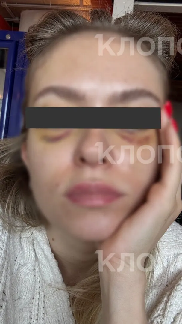 «Пока бьётся моё&nbsp;сердце, я&nbsp;не&nbsp;успокоюсь»: калининградка рассказала о&nbsp;нападении бывшего мужа