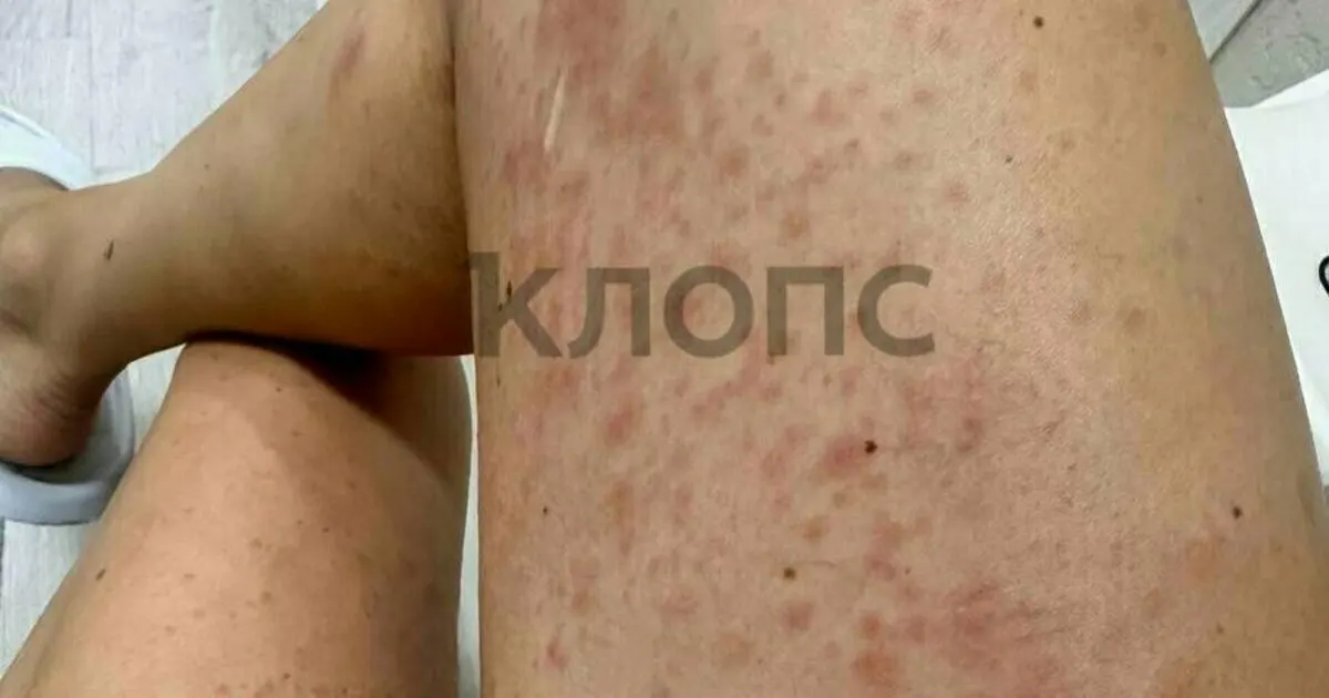 В регионе растёт число пострадавших от гусеницы, чаще всего на Куршской косе; приведены симптомы и простые меры предосторожности.